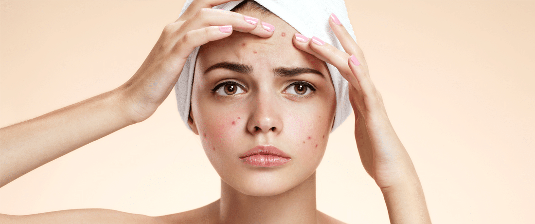 Tratamiento contra el acné, especialistas de la piel muy experimentados contra el acné
