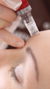 Tratamiento Dermapen