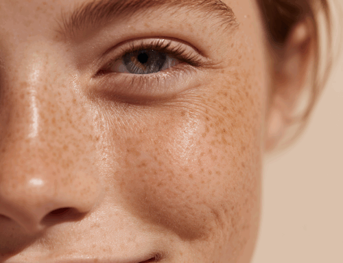 Manchas en la piel: Causas, prevención y tratamientos que sí funcionan